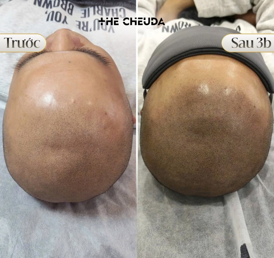 SMP vi chạm sắc tố Biotin Extra là gì? Hiểu đúng về công nghệ độc quyền tại The Cheuda 3 SMP vi chạm sắc tố