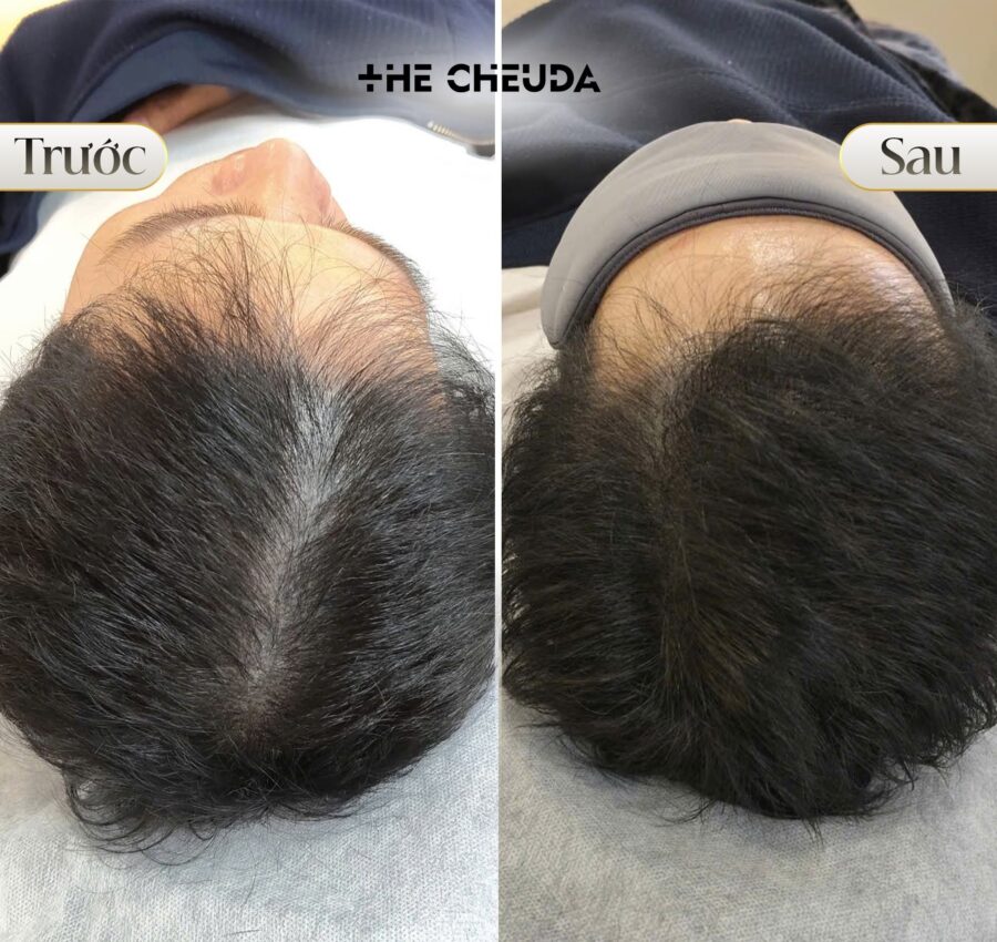 SMP vi chạm sắc tố Biotin Extra là gì? Hiểu đúng về công nghệ độc quyền tại The Cheuda 4 SMP vi chạm sắc tố