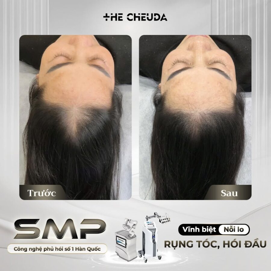 SMP vi chạm sắc tố