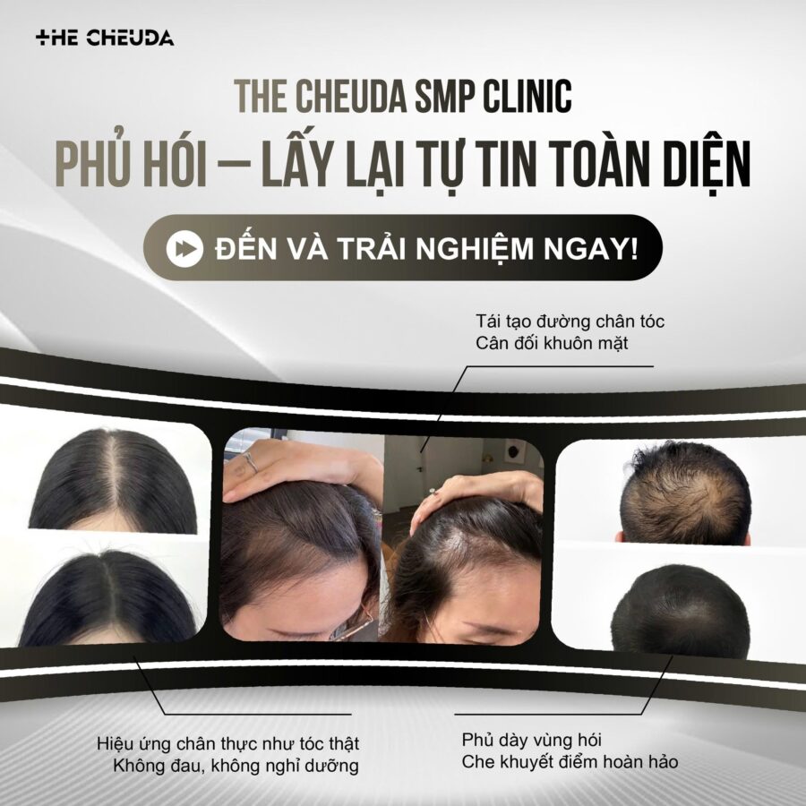 SMP vi chạm sắc tố