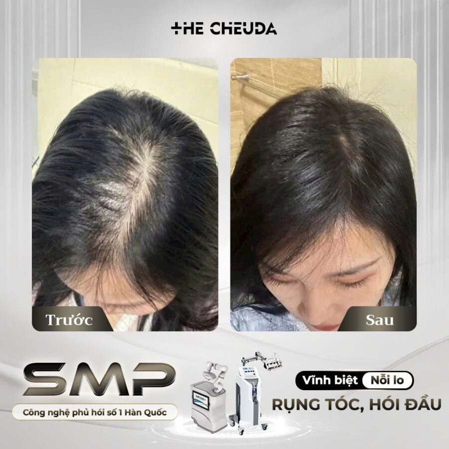 SMP vi chạm sắc tố