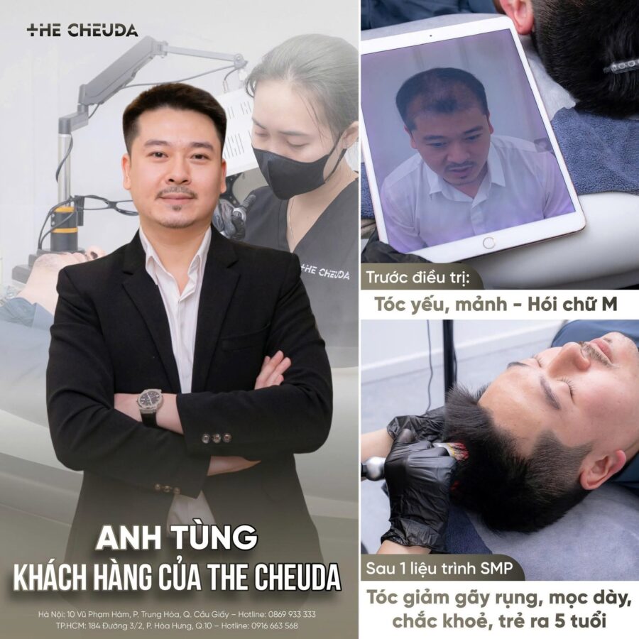 SMP vi chạm sắc tố