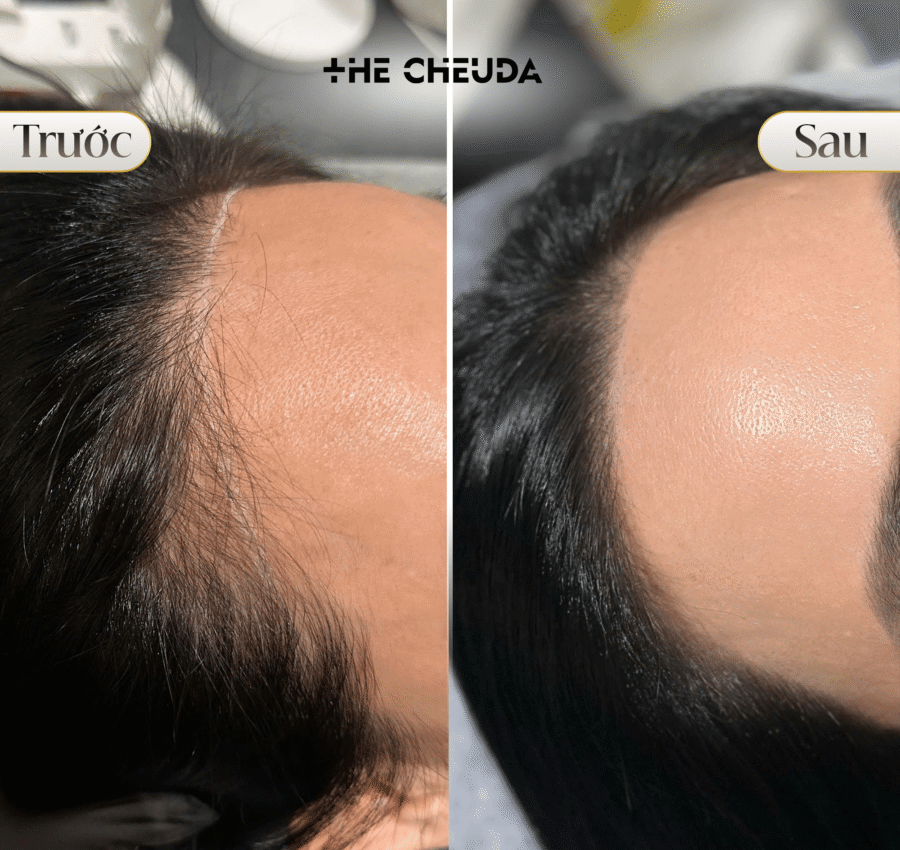 SMP Vi chạm sắc tố da đầu là gì? Giải pháp cứu cánh cho người hói đầu từ The Cheuda 2 Vi chạm sắc tố da đầu