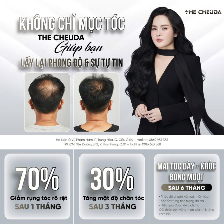 Vi chạm sắc tố da đầu SMP có tốt không? Sự thật về công nghệ không dùng mực xăm 3 Vi chạm sắc tố da đầu SMP