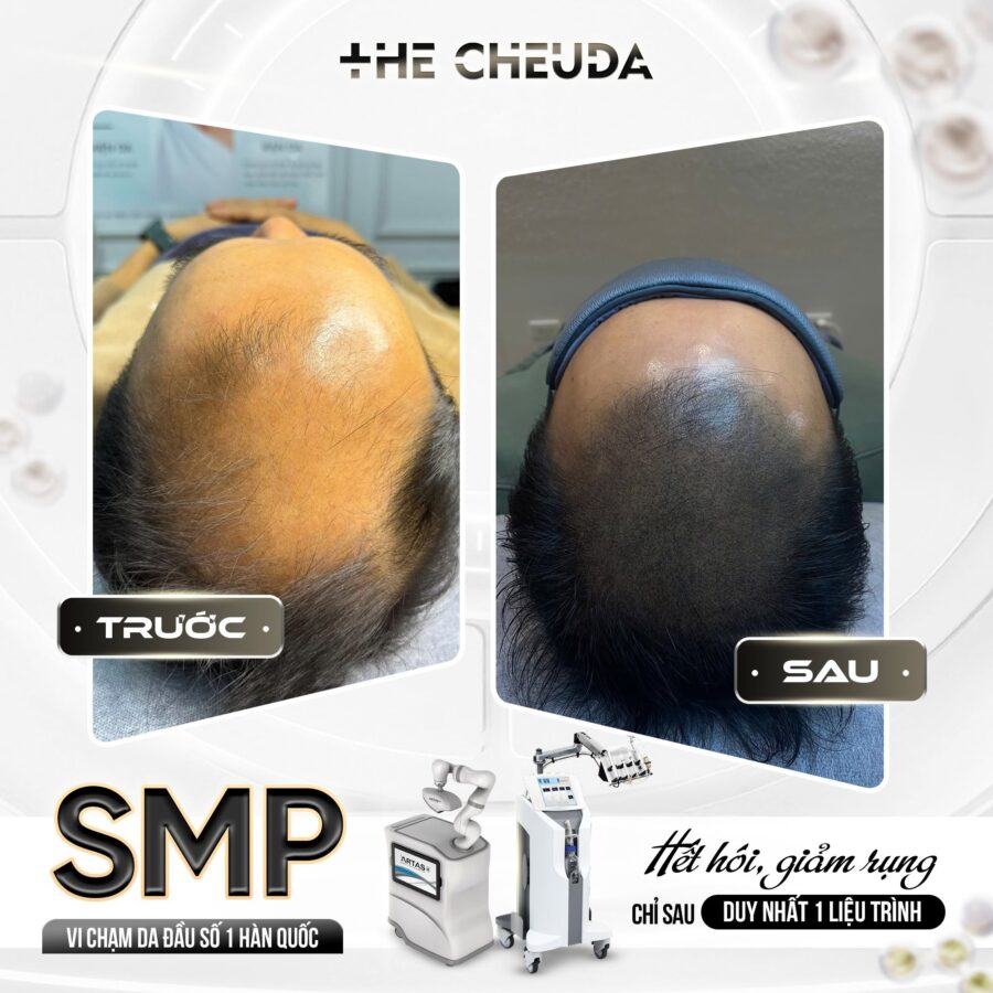Vi chạm sắc tố da đầu SMP có tốt không? Sự thật về công nghệ không dùng mực xăm 4 Vi chạm sắc tố da đầu SMP