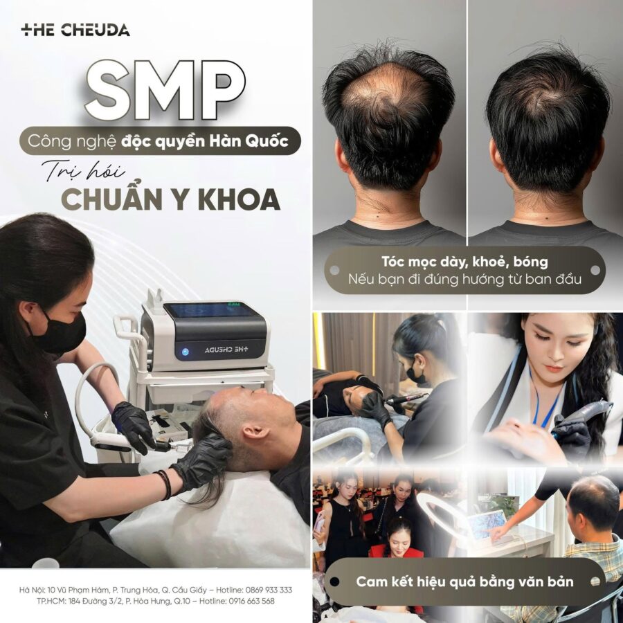 Vi chạm sắc tố da đầu SMP có tốt không? Sự thật về công nghệ không dùng mực xăm 5 Vi chạm sắc tố da đầu SMP