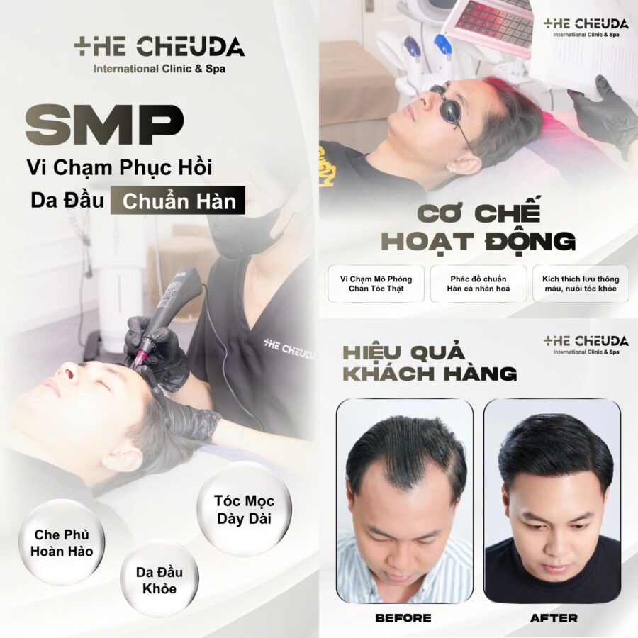 SMP Vi chạm sắc tố da đầu là gì? Giải pháp cứu cánh cho người hói đầu từ The Cheuda 1 Vi chạm sắc tố da đầu