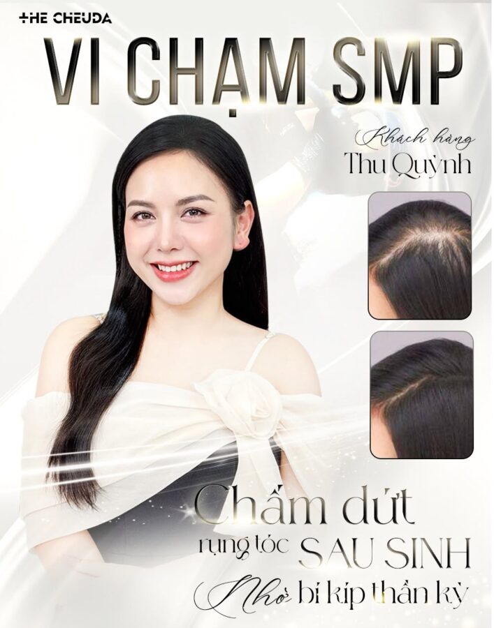 vi chạm sắc tố da đầu SMP