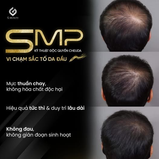 Vi chạm sắc tố da đầu SMP