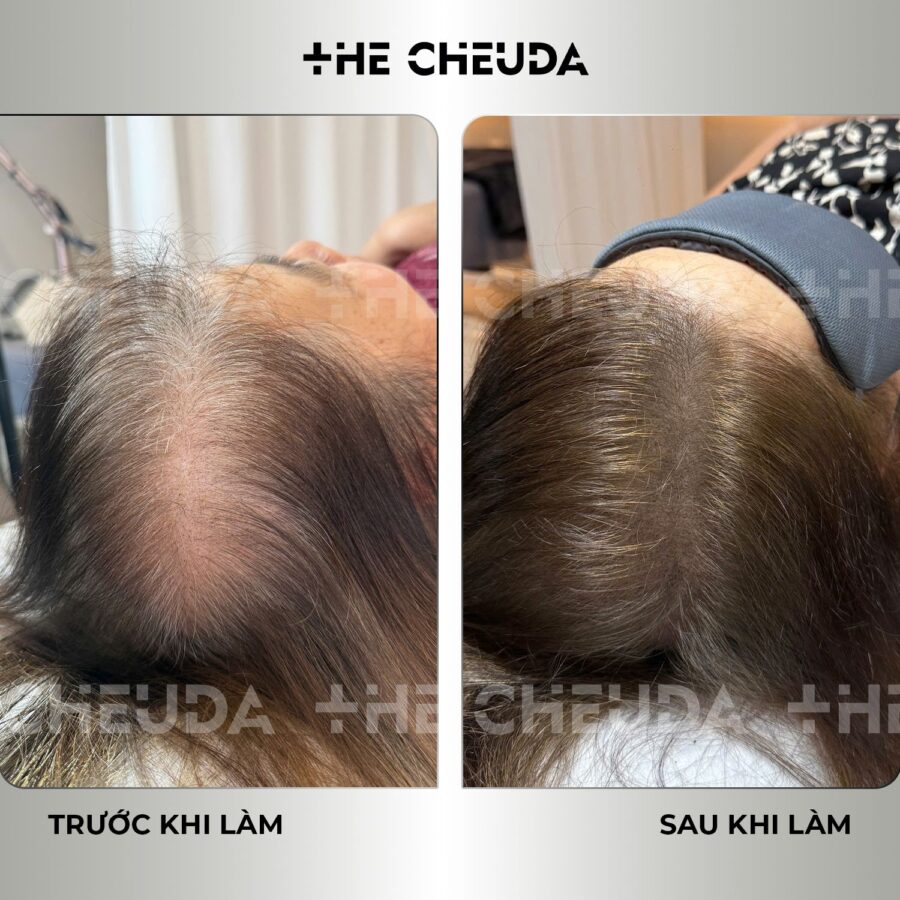 Vi chạm sắc tố da đầu SMP